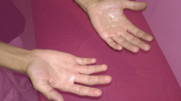 Aşırı El Terlemesi Belirtileri ve Tedavisi